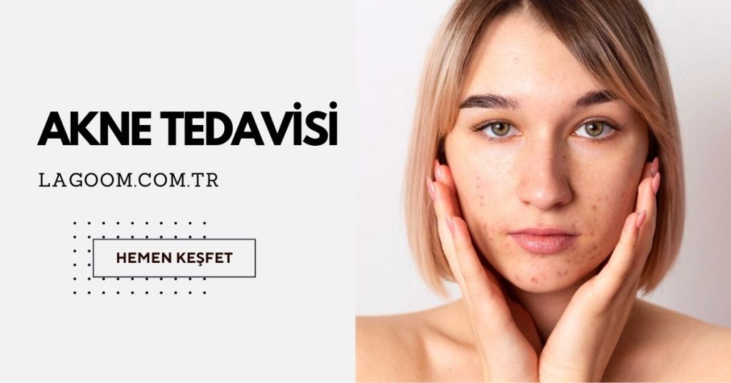 akne tedavisi